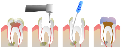 Root Cannel